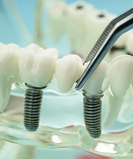 Dental Implants