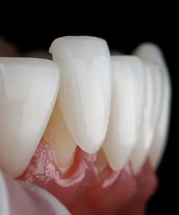 Dental Veneers